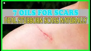 Best 7 Essential Oils For Scars - How To Get Rid Of Scars Naturally? | Best Home Remedies