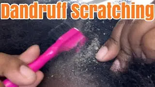 Dandruff Scratching | Soften Flakes ?!