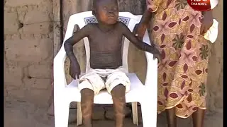 9years child suffering from Strange skin disease