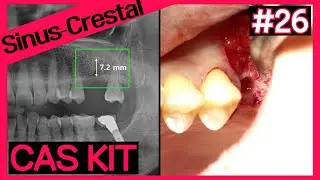 [Online Surgery] Easy Sinus Elevation with CAS KIT