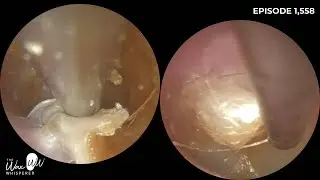 1,558 - Layers of Dead Skin Stripped Away from Ear (Part 2)