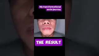 My Transformational Smile Journey Part 2 #veneers