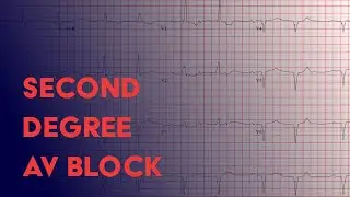 Second Degree Heart Block -  Electrocardiogram (ECG/EKG) Interpretation