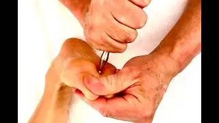 Deep Foot reflexology massage using tools to correct a bunion and tight feet. Brandon massaging Elle