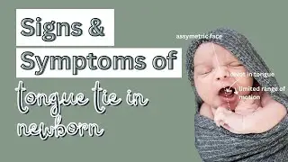 Does baby have a tongue tie? Symptoms of tongue tie in newborn explained by Lactation Consultant