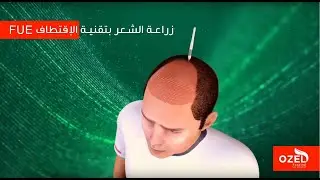 كيف تتم عملية زراعة الشعر بتقنية الإقتطاف FUE