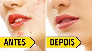 Tratamento Pós-Acne para Se Livrar das Cicatrizes em 3 Dias