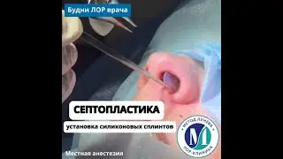 Септопласика.