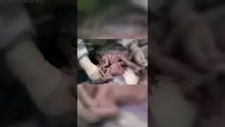 Children's Hospital of Philadelphia successfully separates conjoined twin boys
