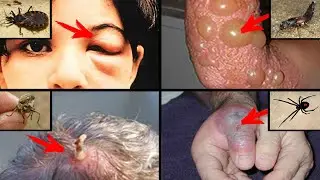 25 Укусов насекомых, которые нужно уметь распознавать