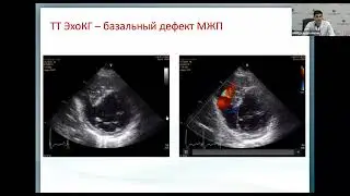 Кардиогенный шок при механич осложнениях И М Аветисян Э.А.