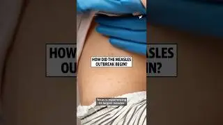 Why is there a measles outbreak in the U.S.?