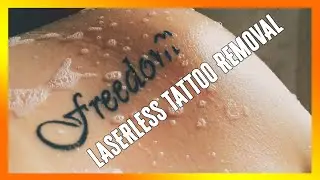 Laserless tattoo removal guide review - Does it Work? Must Watch