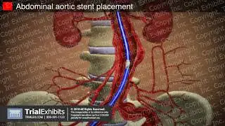 Abdominal Aortic Stent Placement