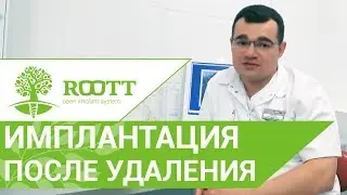 👄 Можно ли ставить имплант после удаления зуба. Имплантация зубов после удаления. 12+