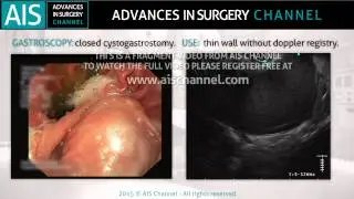 Cystogastrostomy outside the operating room