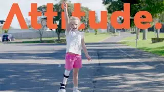 Six-Year-Old Remarkable Recovery Living With Proximal Femoral Focal Disorder