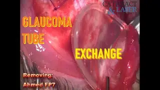 How to TUBE SHUNT: Glaucoma Tube Shunt Surgery Exchange
