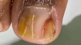 Unha Com Fungo #ingrowntoenail  Kelly