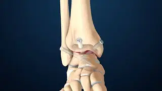Fusión de Tobillo Anterior