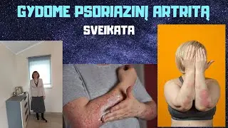 Sveikata | Gydome psoriazinį artritą
