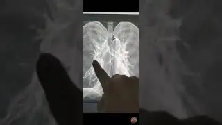 Coronavirus 3d Lungs 🫁, please take vaccine #ytshorts