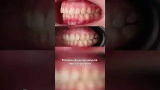 Как меняется улыбка после брекетов
