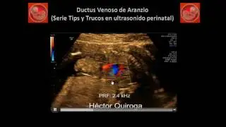 Serie Tips y Trucos en Ultrasonido Perinatal: Ductus Venoso de Aranzio