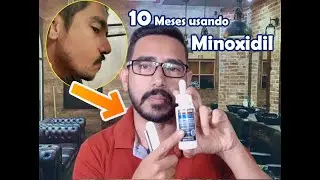 10 meses usando minoxidil