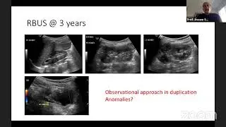 upper Vs lower tract approach for dublication anommalies