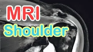 MRI For Shoulder