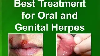 Best Genital Herpes Treatment Cure in Nashville, TN