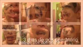 Ortognática ex classe III - Raquel Matos
