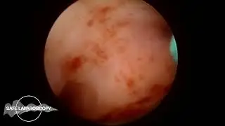 Hysteroscopic resection of two endometrial polyps technique