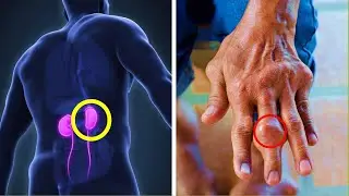 Prevent Gout and Kidney Stones By Avoiding These Purine-rich Foods
