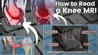 How to Read a Knee MRI | Medical Technology