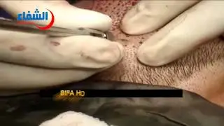 الاقتطاف دار الشفاء لزراعة الشعر للحجز  00905555558555