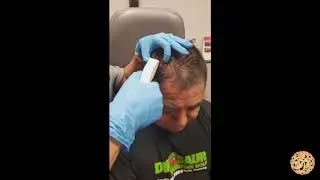 Scalp Laceration Fixed With Staples - Fast & Effective Treatment!