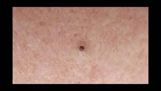 Dilated Pore of Winer Giant Open Pore