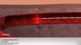 Phlebology - GVS Treatment - Trattamento Safena LASEmaR 1500 + Optical Fiber RING 3D