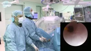 Inspection of the ureter for residual fragments