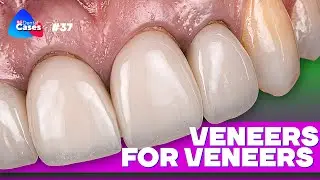 Veneers for Veneers | BG Dental Cases #37