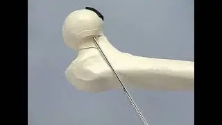 femoral neck fracture fixation with cannulated screws