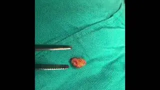 parotid gland sialolith,tükrük bezi taşı