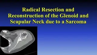 Radical Resection and Reconstruction of the Glenoid and Scapular Neck due to a Sarcoma