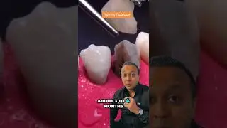 The BEST Option for a Split Tooth!