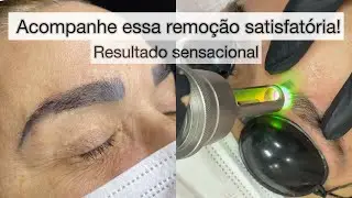 Remoção a laser com resultado incrível!