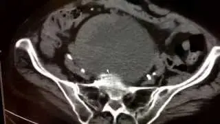 Pelvic mass