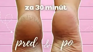 Ako sa zbaviť stvrdnutej kože na pätách