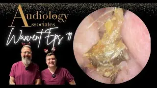 THICK EAR WAX PLUG REMOVED WITH FORCEPS - WAXVENT 11